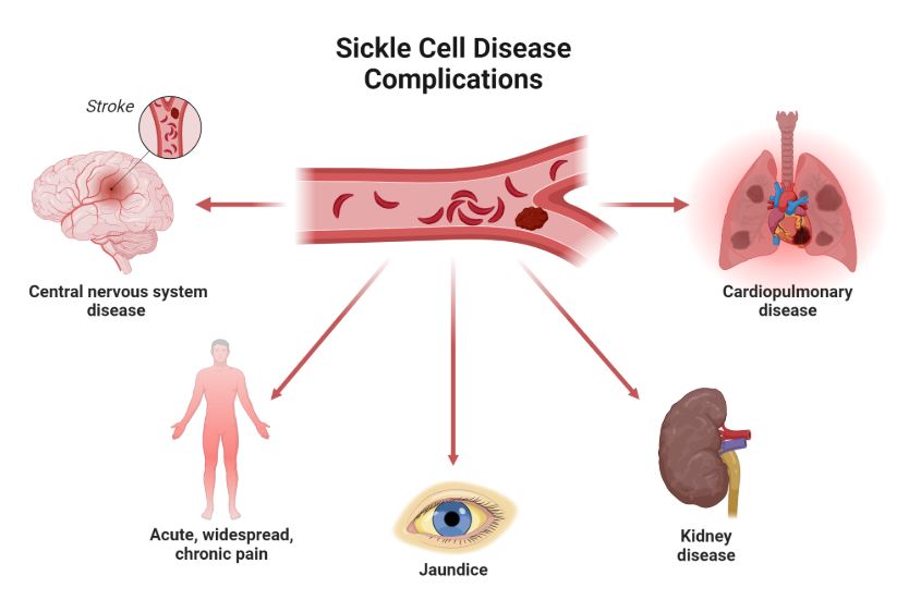 Sickle Cell