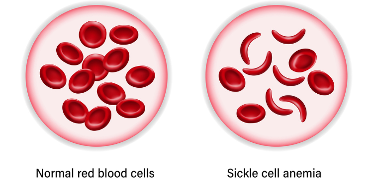 Sickle Cell